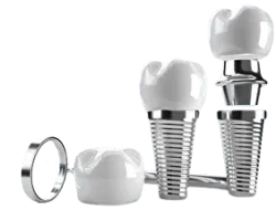 Имплантация зубов: надежное восстановление утраченных зубов