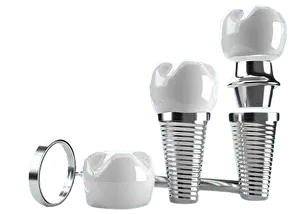 Имплантация зубов: надежное восстановление утраченных зубов